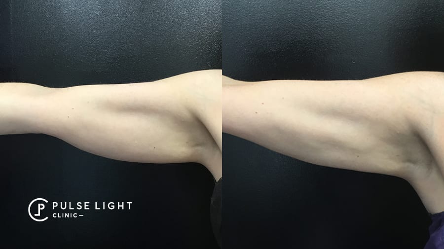 Before and after CoolSculpting on woman's arms