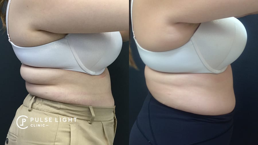 Before and after CoolSculpting on Women's back