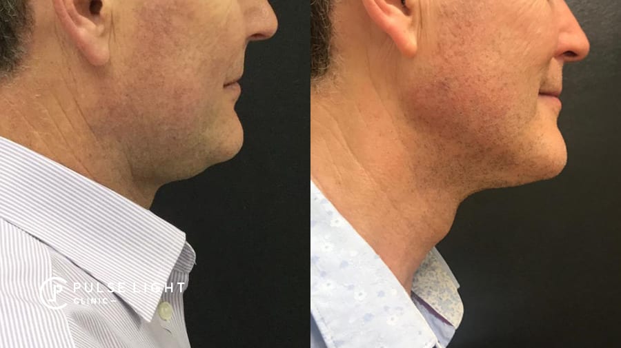 Man double chin before and after