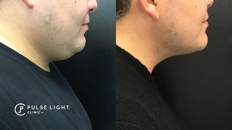 Side profile of man with double chin