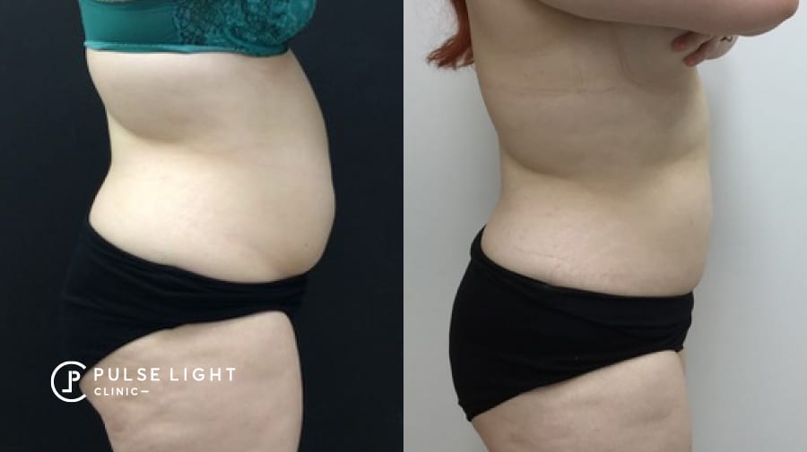 Reduction of fat from lady's abdomen area