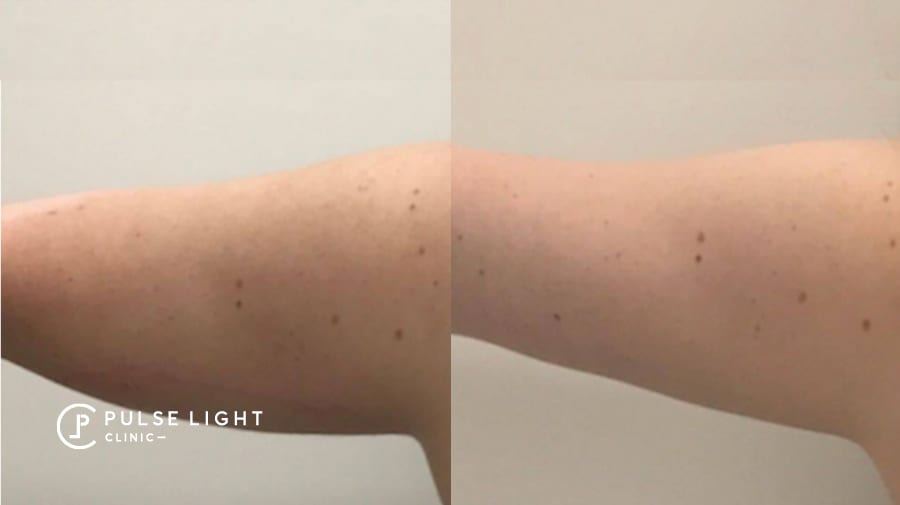 Before and after fat reduction on arms
