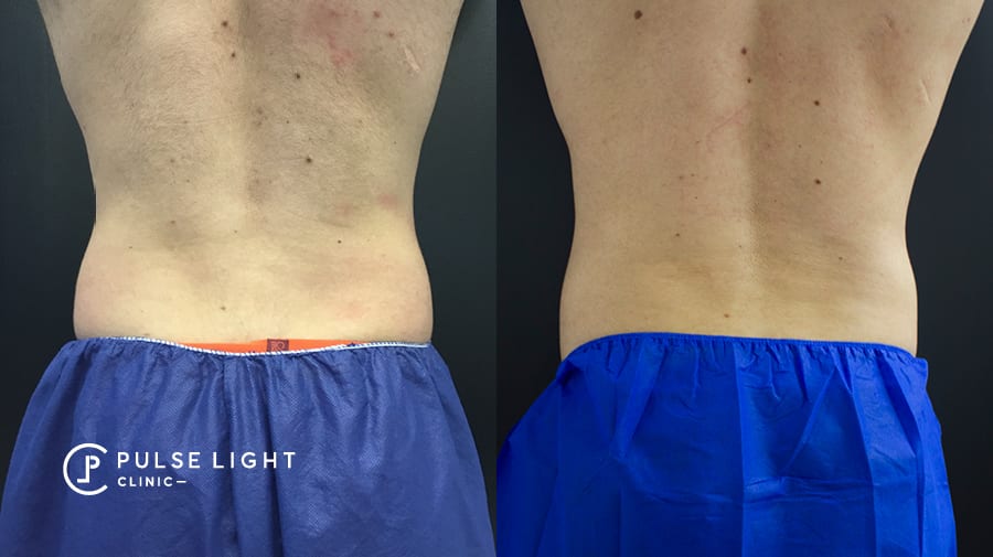 Man before and after CoolSculpting on Love handles