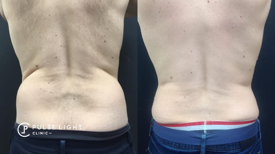 CoolSculpting Treatment for Love Handles—Reduce Unwanted Waist Fat