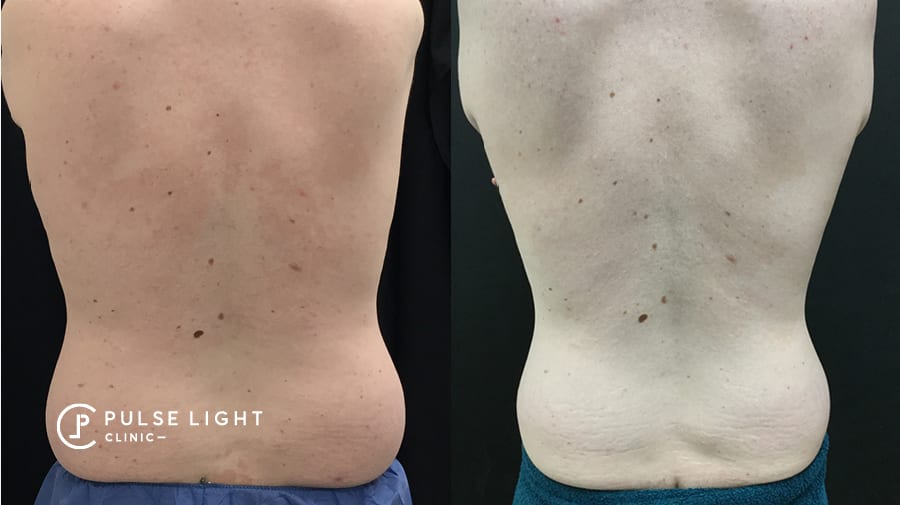 CoolSculpting Love Handles, Coolsculpting flanks before and after