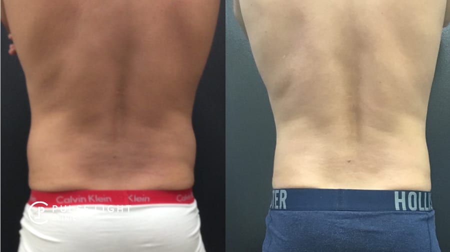 Before and after of a man's back after fat freezing at Pulse Light Clinic