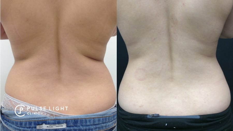 Before and after receiving CoolSculpting on the back area of a client at Pulse Light Clinic