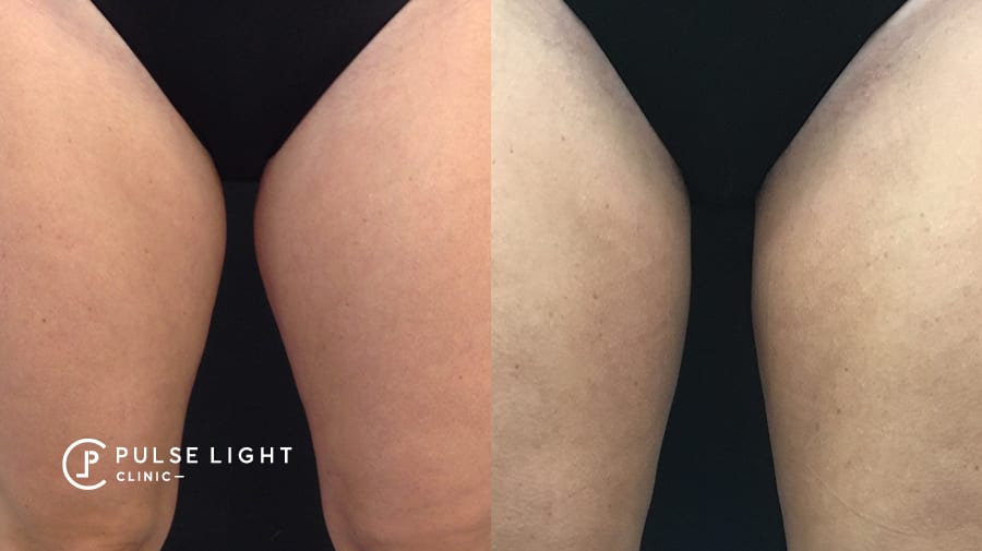 Before and after CoolSculpting on ladies inner thighs