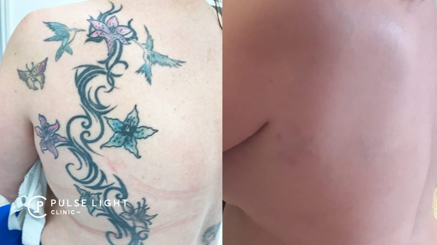 Before and after green tattoo on lady's back