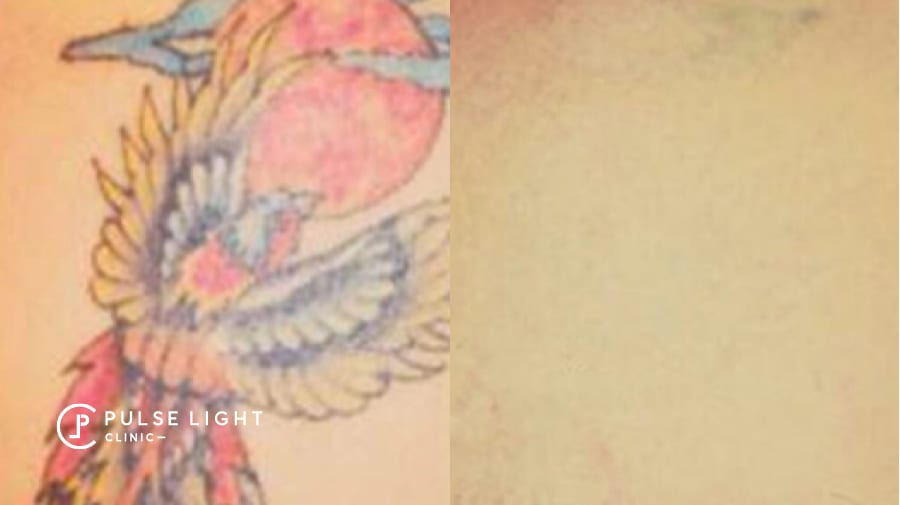 Coloured Tattoo Removal