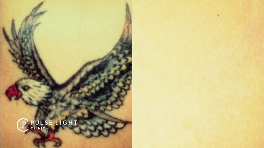 Tattoo removal of bird gone at Pulse Light Clinic