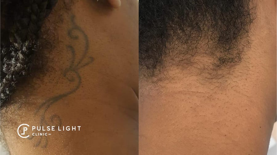 Tattoo removal on dark skin lady near neck area