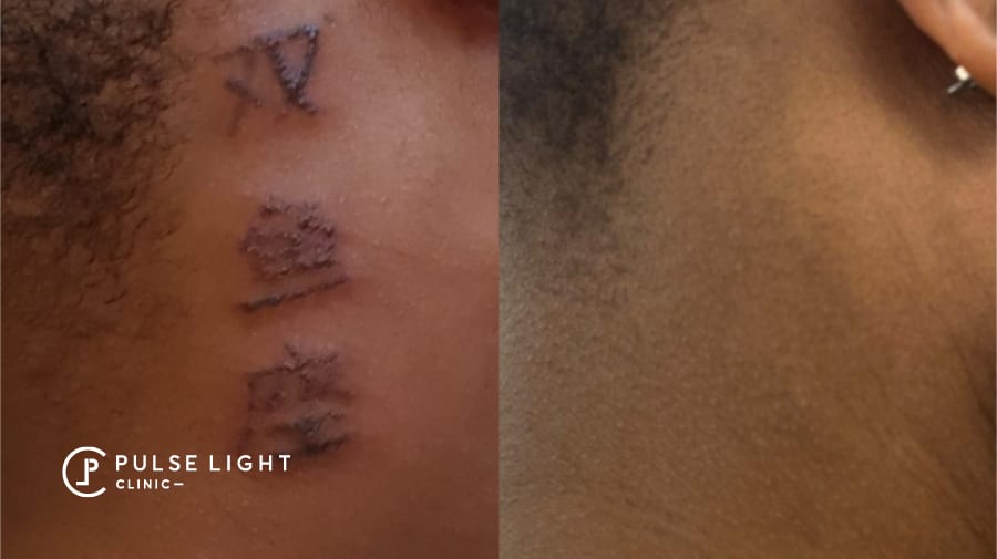 Tattoo removal on dark skined lady at Pulse Light Clinic