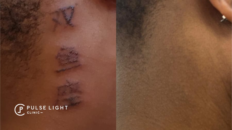 Laser Tattoo Removal London, As seen on BBC London Pulse