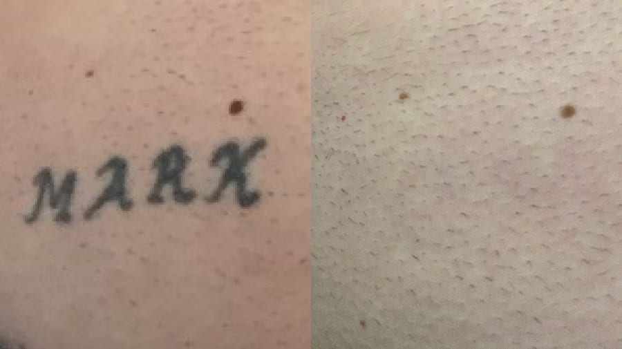 Before and after of tattoo removal of a name on man's chest