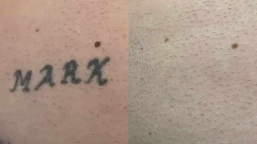 Laser Tattoo Removal in West Bloomfield  Affordable  Chroma Tattoo