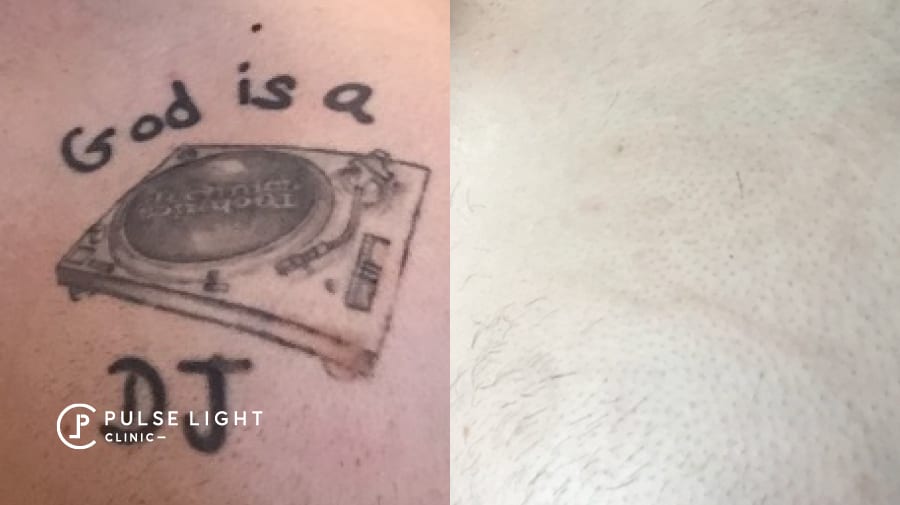 God Is A DJ tattoo removal