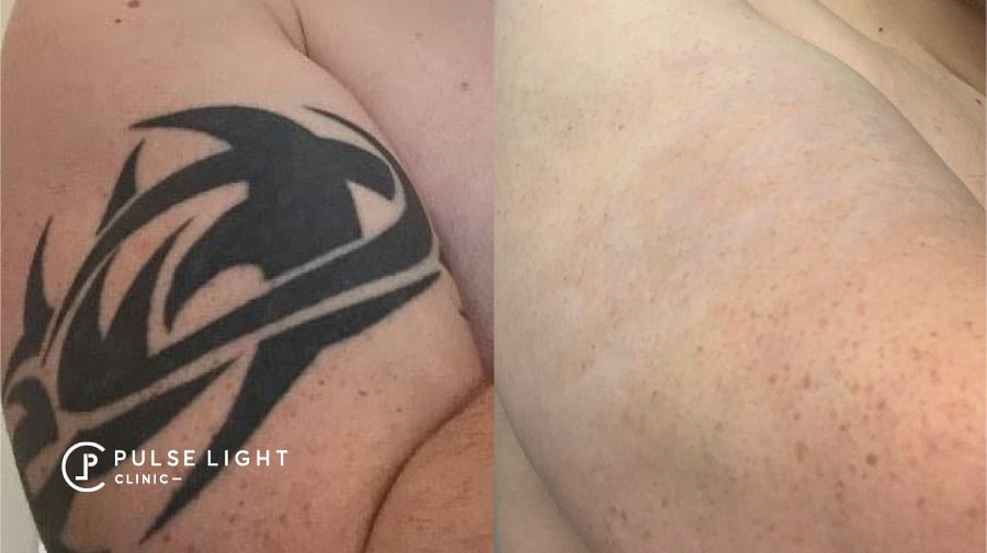 7 Things Everyone Gets Wrong About Laser Tattoo Removal
