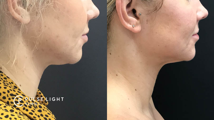 Female Chin Fat Freezing Before and After Results