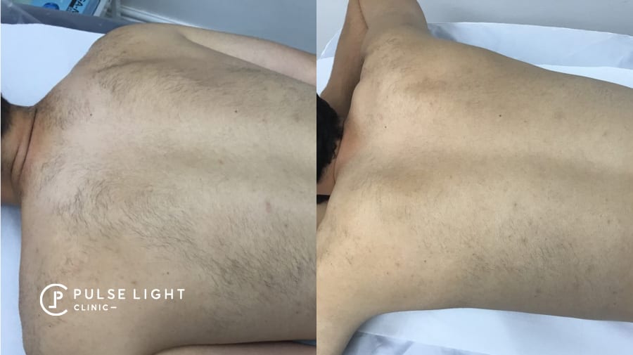 Laser Hair Removal Men | Pulse Light Clinic London