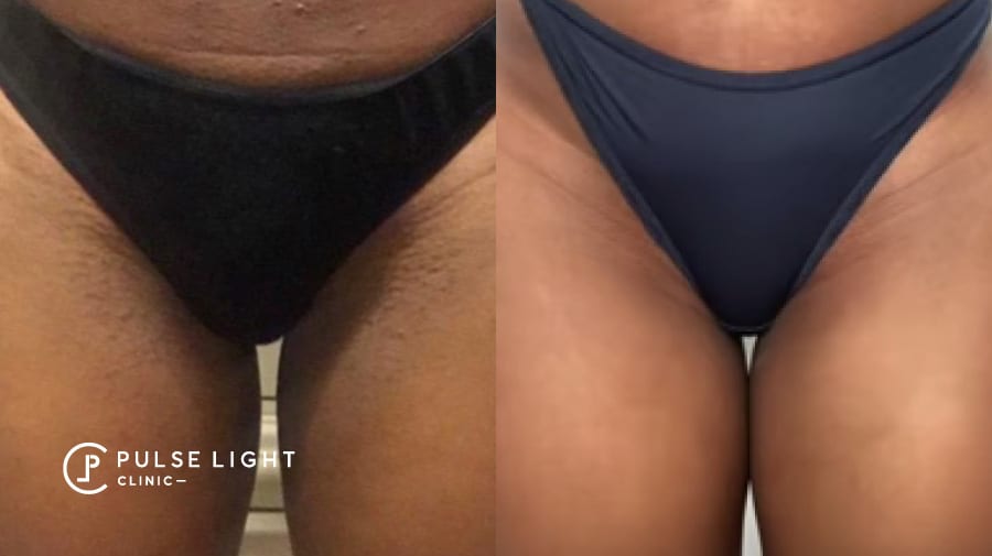 Lady's bikini before and after laser hair removal