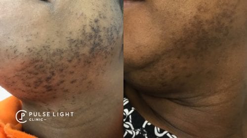 Laser Hair Removal Dark Skin | Pulse Light Clinic London