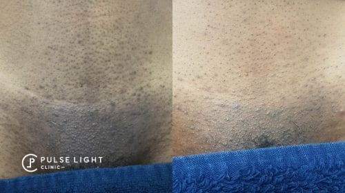 Laser Hair Removal Dark Skin | Pulse Light Clinic London