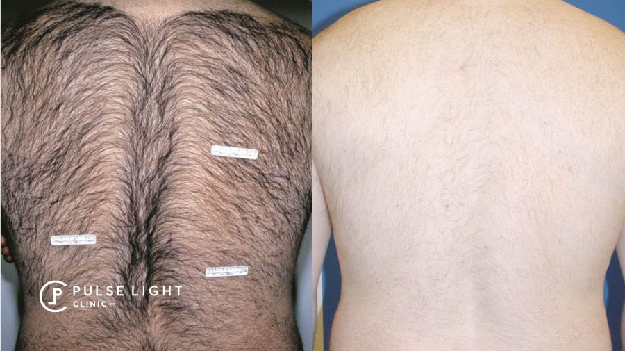 Laser Hair Removal For Men | The Skin To Love Clinic
