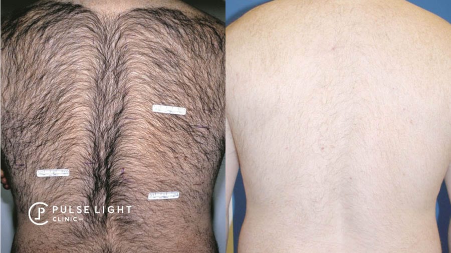 Laser Hair Removal Men | Pulse Light Clinic London