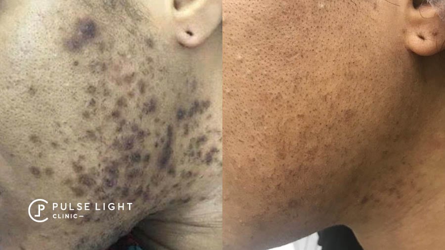 Side profile view of lady's face showing the difference after getting laser hair removal, ingrown hairs gone