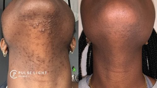 Side profile view of lady's neck showing the difference after getting laser hair removal, ingrown hairs gone