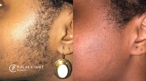 Laser Hair Removal Dark Skin | Pulse Light Clinic London