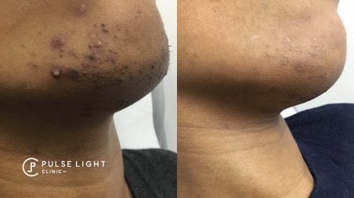 Laser Hair Removal Dark Skin | Pulse Light Clinic London