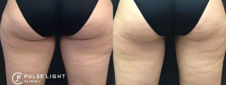 CoolSculpting Thigh Results Blog Post