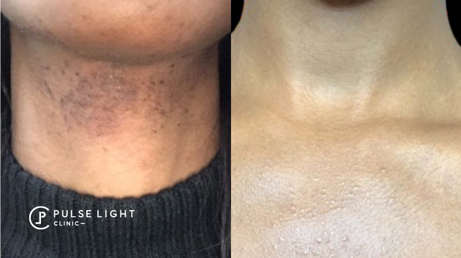 What is Laser Hair Removal | Pulse Light Clinic London