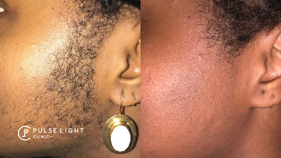 PCOS Laser Hair Removal Pulse Light Clinic London
