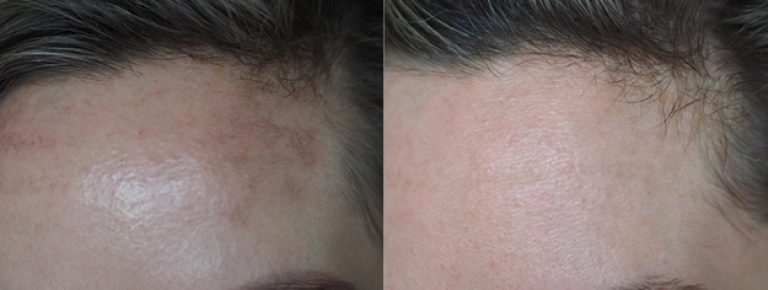 PicoSure before and after results