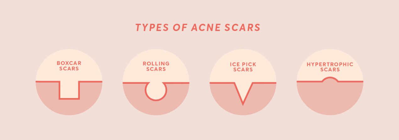 acne scar types