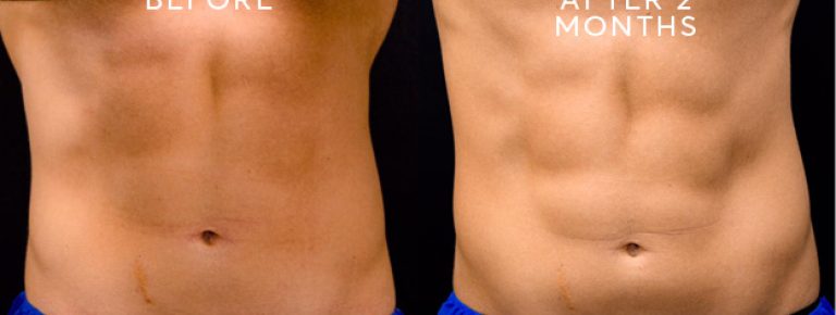 Can You Get A Six Pack With EMSculpt Pulse Light Clinic London