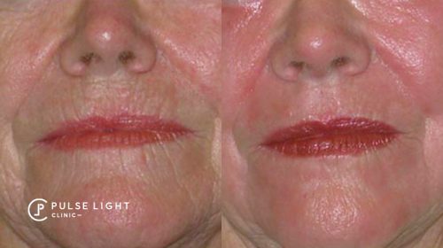 resurfacing around mouth laser