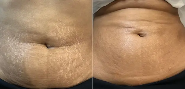Stretch mark shop removal near me