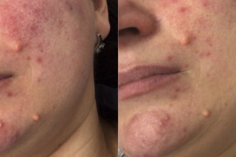 Rosacea Treatment Results