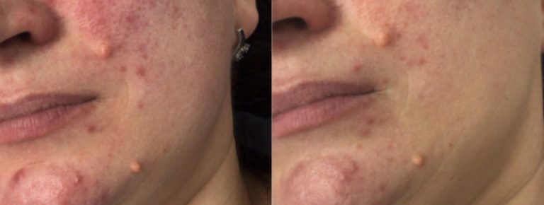 Rosacea Treatment Results
