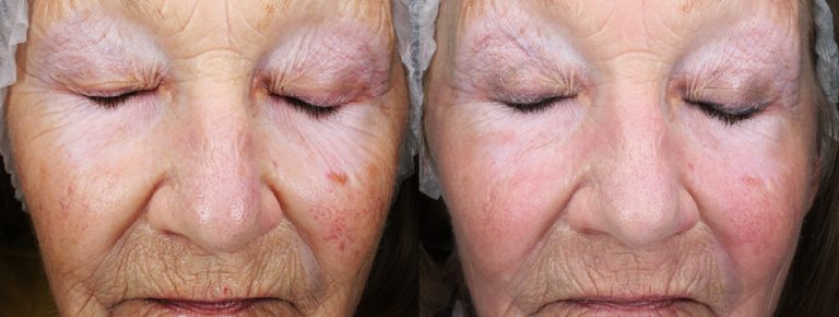 Ablative laser face resurfacing
