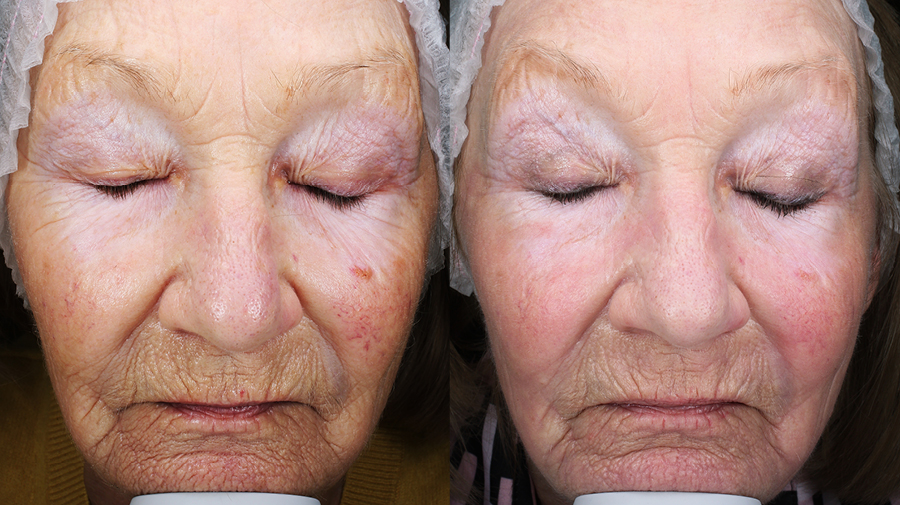 Fractional CO2 Laser Before and After Photos