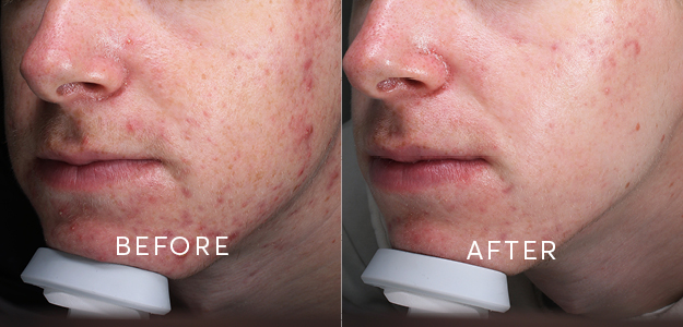 Before and after acne treatment