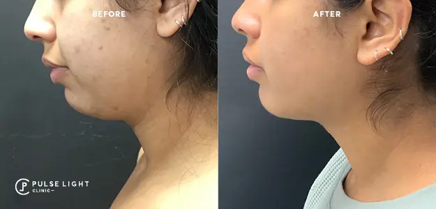double chin removal before and after
