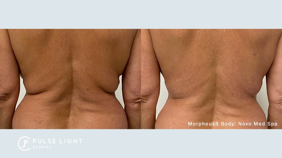 Morpheus8 back