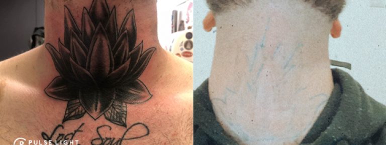 The Most Effective Laser Tattoo Removal | Pulse Light Clinic London