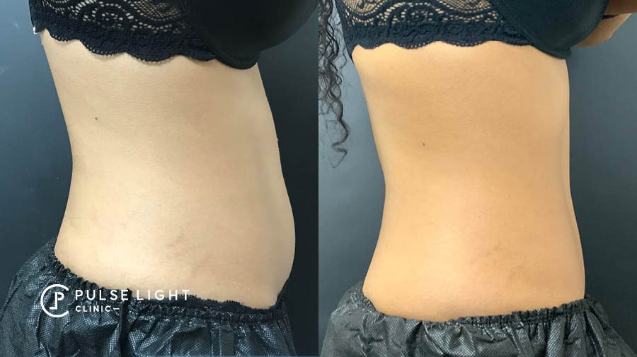 coolsculpting before and after lower belly